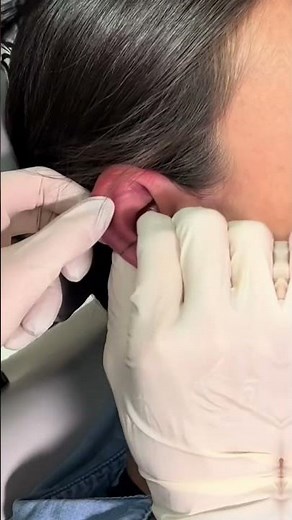 Conch piercing using base laboratories piercing aftercare spray to reduce piercing bumps 😍