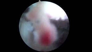 Fracture of the anterior tibial spine, Arthroscopic fixation.