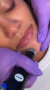 10K views · 29 reactions | Hydrafacial painless extractions  Removes impurities from pores with painless gentle suction. Drop your skin goal below and we’ll start working towards it ✨ Link in bio to find a Hydrafacialist near you. #hydrafacial | Hydrafacial | Facebook