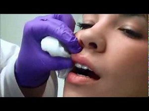 Lip Augmentation