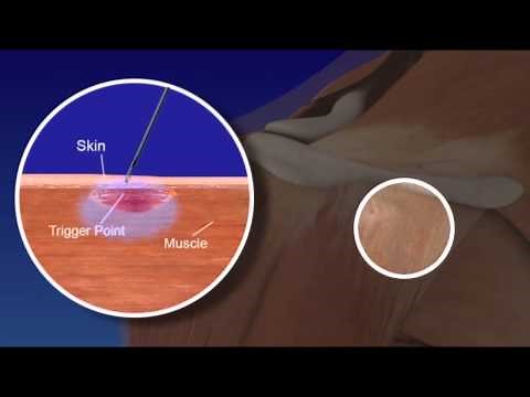 Trigger Points & Trigger Point Injections