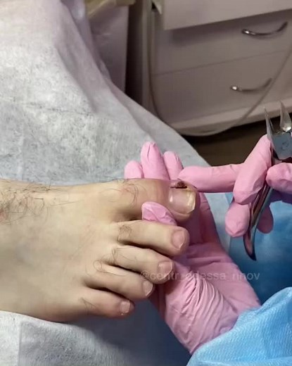 Убрали вросший за 7 шагов. #вросшийноготь #онихокриптоз #подолог #подология #подологнижнийновгород #подологнн #педикюрнн #педикюрнижнийновгород