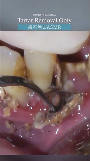 歯石除去ASMR Tartar Removal Only Part1 #ザホワイトデンタルクリニック #歯医者 #歯石除去 #歯石