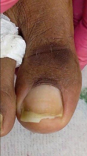 "How to Fix Yellow & Damaged Toenails 💛🦶 | Doctor’s Guide"