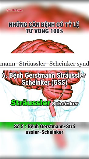 Bạn sẽ chết nếu mắc phải căn bệnh này - phần 6 : Bệnh Gerstmann-Strässler-Scheinker | BiologyZ