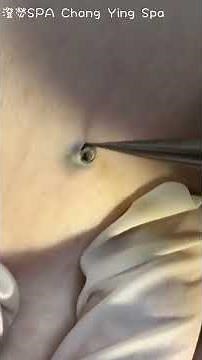 Deep DPOW extraction - Dilated Pore of Winer extraction - ChangYing Spa