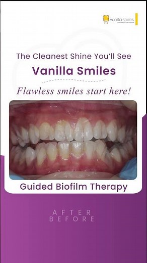A shine you can see - and gums you can feel ✨🦷 Guided Biofilm Therapy