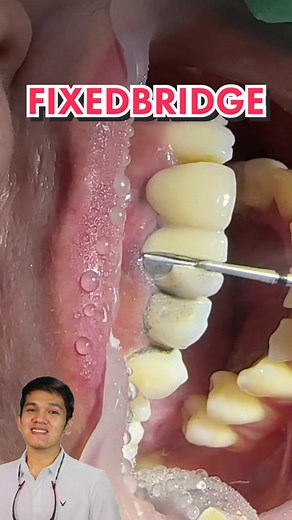 Fixed Bridge Removal: Learn How on TikTok