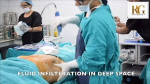 SAFE Liposuction is process of separation, aspiration and fat...