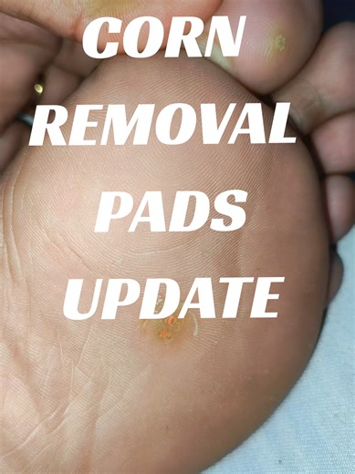 Effective Corn Removal Pads for Foot Issues: Update
