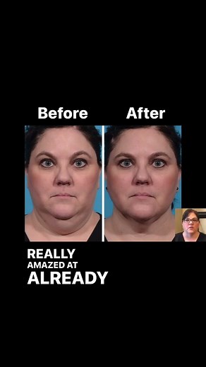 FaceTite Procedure Before and After | Avance Plastic Surgery: Dr. Erez Dayan | Reno, Tahoe, NV