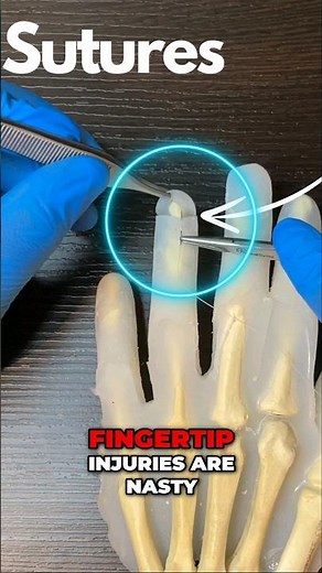 Nailbed Repairs: The expert way meded #medicalstudent #nailbed #orthopedicsurgeon #trauma #suturing