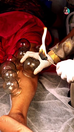 Fire Cupping Treatment 🔥.. #shorts #skincare #cuppingtherapy