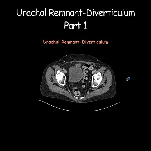 Urachal Remnant-Diverticulum Part 1 #radiology #radiologist #embryology #urinarybladder