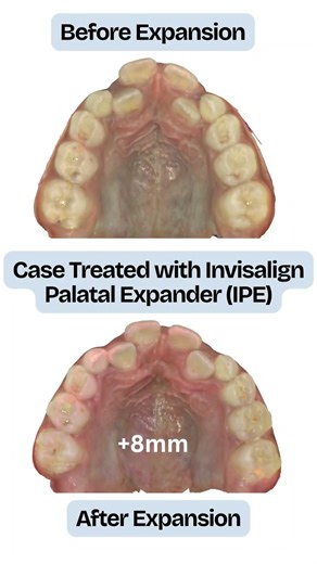 Invisalign Palatal Expander works? | Before After |