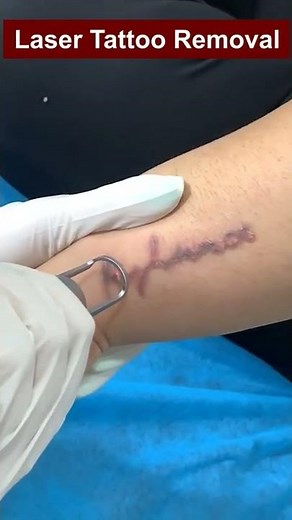 Everyone Loves Laser Tattoo Removal #shorts #lasertattooremoval #skinaaclinic
