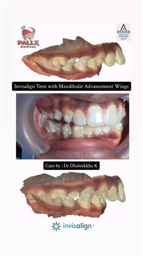 🎖️INVISALIGN DIAMOND 💎 CLINIC JOHOR BAHRU on Instagram: "A steady progress in this Invisalign Teen case 🤍 Using mandibular advancement with Precision Wings, we are gently guiding the lower jaw forward in a controlled and comfortable way, supporting balanced jaw development during this important growth phase. These scans allow us to appreciate the changes taking place , improving jaw alignment, a more harmonious bite, and better arch coordination, all unfolding gradually as planned. It’s reass