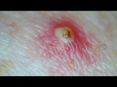 Infected ingrown hair on shoulder