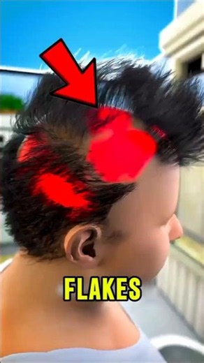 Dandruff Mistakes That Could Leave You BALD! 😱