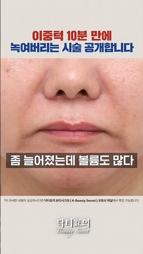 Fat-melting lifting? The real effects of Onda Lifting