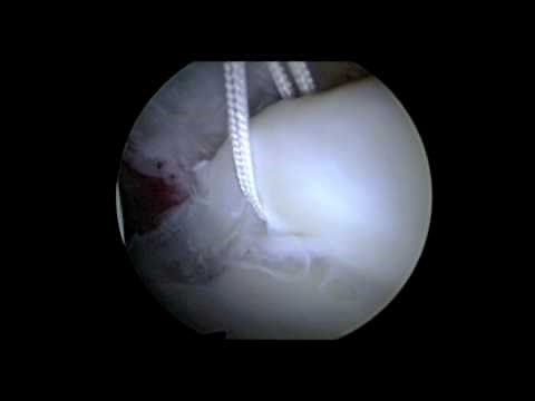 Hip Arthroscopy Labral Repair Surgery - Repair Torn Hip Labrum - Dr. David J. King