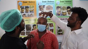 10 ரூபாய்க்கு முடி cheapest hair transplant in chennai | transplant...