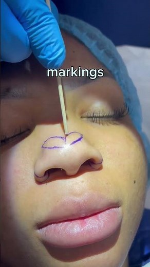 NASAL TIP REFINEMENT - DR. TANVEER JANJUA