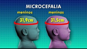 Ministério da Saúde altera medição cefálica de bebês com suspeita de microcefalia