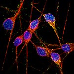 Researchers Induce Alzheimer’s Neurons From Pluripotent Stem Cells
