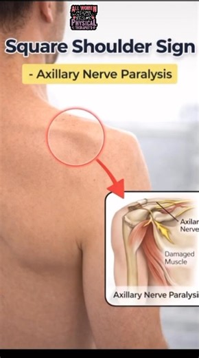 Clinical Signs Every Physiotherapist Must Know 🥼 #physiotherapist #medicalshorts #physicaltherapy