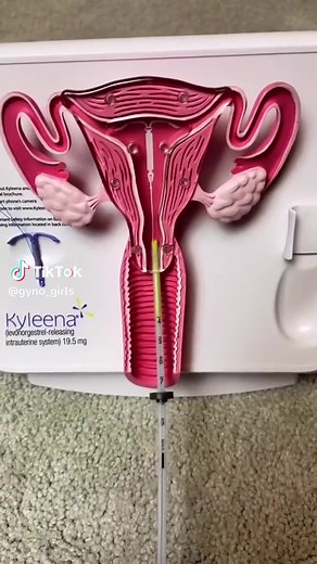 Understanding IUDs: Hormonal vs Non-Hormonal Options