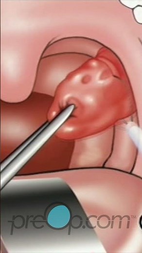 🩺 Tonsillectomy Explained: Surgery & Recovery 🏥 #shorts #preop #healthcare Pt. 2