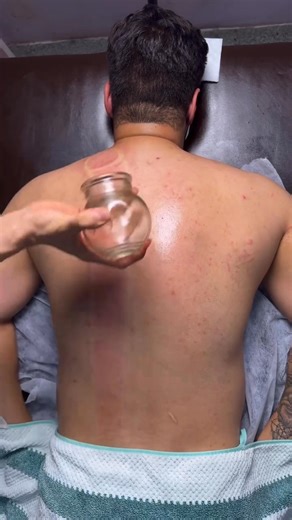 Fire Cupping is an ancient technique used in traditional Chinese medicine that involves placing heated glass cups on the skin to create suction. This suction helps stimulate blood flow, loosen tight muscles, and encourage lymphatic drainage. Though it leaves circular marks, it’s generally painless and deeply relaxing. 🔥🩵 While we don’t perform fire cupping at our clinic, it’s an incredible modality practiced by skilled professionals—and we love seeing this kind of work shared! #FireCupping #Ci