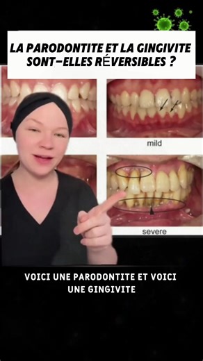 #tooth #dent #dents #dentifrice #toothpaste