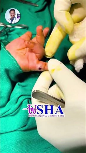 Extra Finger Removed Successfully | Polydactyly Surgery by Dr. Suneel Kishore