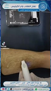 18 reactions | #Achilles #tendon #injection | Ahmed Aboelnsr | Facebook