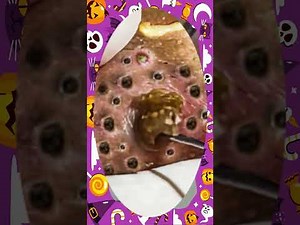 Blackheads Removal #169 | Acne Treatment and Very Satisfying Satisfying Pimple pop #blackheads