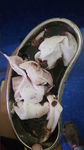 Hematemesis is the vomiting of bright red blood or dark coffee-ground material