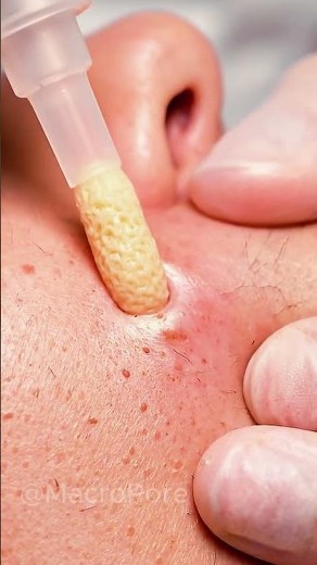 Extreme Close-Up: Vacuum Comedone Extraction in 4K