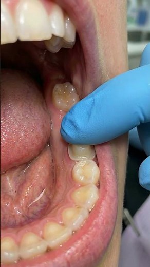 How Dentists Prepare Teeth for a 2-Unit Bridge | Fixed Bridge Animation #dentist #shorts #asmr