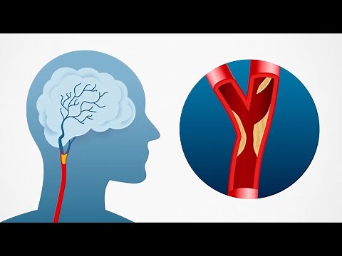 What is Carotid Artery Disease and How is it Treated?