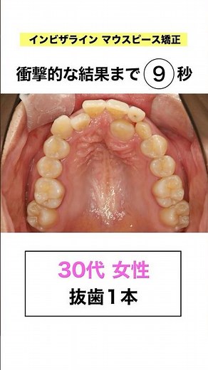 斎藤式マウスピース矯正 #マウスピース矯正 #歯医者 #歯列矯正