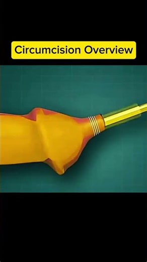 CIRCUMCISION OVERVIEW! Disclaimer: This video is for educational #CircumcisionUSA #USHealth