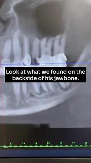 As you can see from the cone beam CT scan, the patient had three large abscesses on the left side of his jaw. One abscess was so large that it was exposed on the backside of the tooth. These abscesses were causing the patient's health problems, but they were not visible on a regular dental X-ray. #conebeamctscan #jawissues #jawbone #tmj #healthissues #abscesses