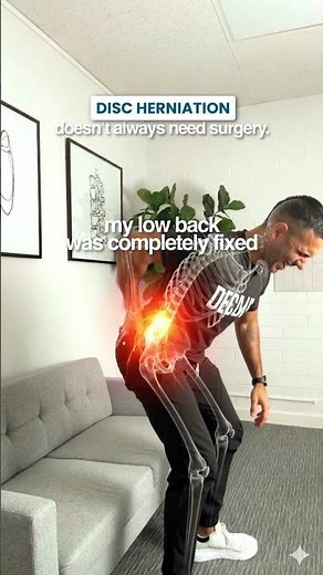 How spinal decompression relieved my L5-S1 pain and avoided surgery #SciaticaRelief #BackPain