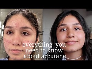 after my accutane experience (results, side effects, price, questions)