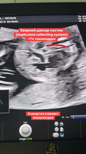 Ургийн бөөрний давхар систем (duplicated collecting system) илэрч, дээд бөөрний туйлын ureter нь давсагт орох хэсэгтээ өргөсч ‘ureterocele’ үүсгэсэн байна. Энэ нь шээсний урсгалыг хааж, аяганцар–тэвшинцэр өргөсөхөд хүргэдэг ч төрсний дараа мэс заслаар эмчлэгддэг. 👈For doctors-(please read this article ☝️)Fetal urinary tract dilation: What to tell the parents….prenatal diagnosis journal | Azjargal Clinic - Азжаргал Клиник