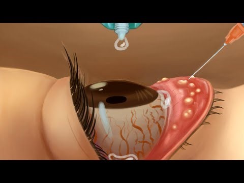 ازاي بتتكون احجار داخل العين؟! وشاهد كيف يتم ازالتها _ eye stone removal (ASMR)