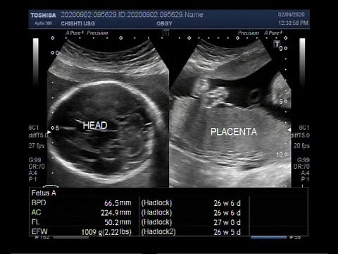 Ultrasound Video showing a case of pregnancy with Polyhydramnios.