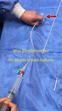 👶🏻 The Cook's Balloon: Everything You Need to Know About Labour Induction #shorts